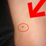 足の裏に茶色のシミが突然できた！足裏の薄い染みを病院で調べた結果…