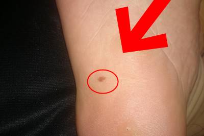 足の裏に茶色のシミが突然できた！足裏の薄い染みを病院で調べた結果…
